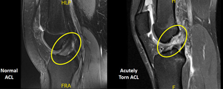 ACL Reconstruction