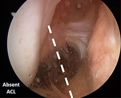 ACL Reconstruction