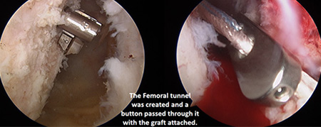 ACL Reconstruction