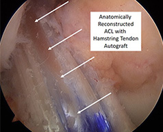 ACL Reconstruction