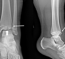 Ankle Growth Plate Fracture