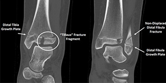 Ankle Growth Plate Fracture