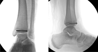 Ankle Growth Plate Fracture