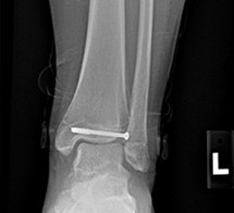 Ankle Growth Plate Fracture