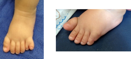 Baby Born with an Extra Toe