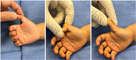 Toddler with a “Bent” Thumb