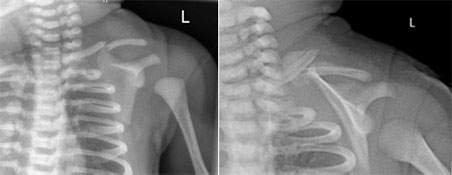 Birth Trauma Cases