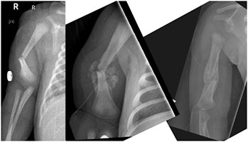 Birth Trauma Cases