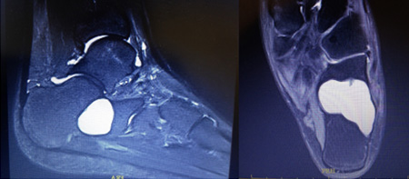Bone Cyst of Foot Causing Pain