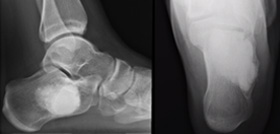 Bone Cyst of Foot Causing Pain