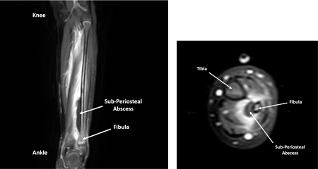 Bone Infection of a Child