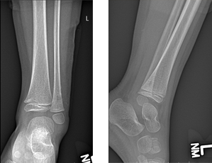 Bone Infection of a Child