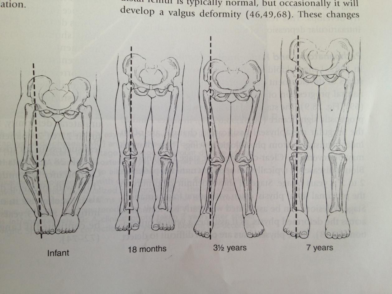 Bow leggedness and Knock Knees