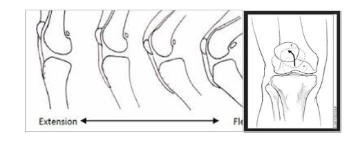 Chondromalacia Patella