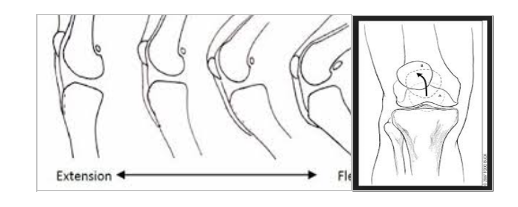  Chondromalacia Patella