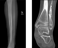 Tarsal Coalition Causing Chronic Foot/Ankle Pain