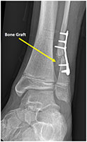 Tarsal Coalition Causing Chronic Foot/Ankle Pain