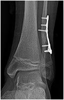Tarsal Coalition Causing Chronic Foot/Ankle Pain