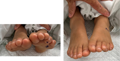 Curly Toe Causing Progressive Deformity and Pain