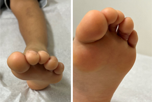 Curly Toe Causing Progressive Deformity and Pain