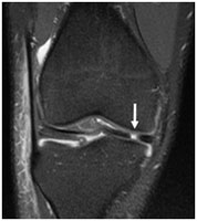 Dancing Knee Meniscus Tear