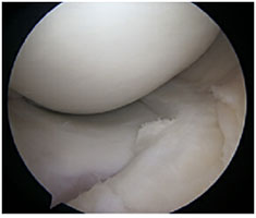 Dancing Knee Meniscus Tear