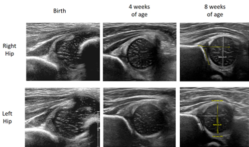 Developmental Dysplasia of the Hip in a Newborn