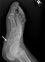 Extra Bone in the Foot Causing Pain
