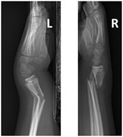 Fall off of a Swing with Bilateral Wrist Fractures