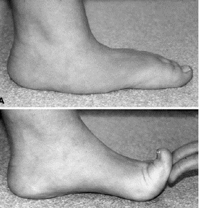 Flatfeet in Children and Adolescents