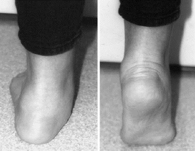 Flatfeet in Children and Adolescents