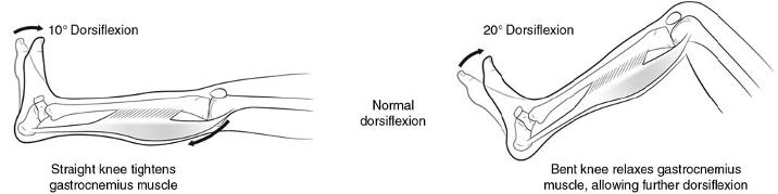 Flatfeet in Children and Adolescents