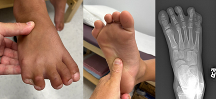 Polysyndactyly of the Foot Causing Toe Deformity with Growth