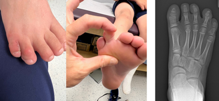 Polysyndactyly of the Foot Causing Toe Deformity with Growth