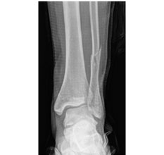 Football Ankle Fracture