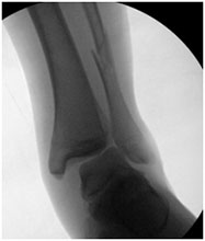Football Ankle Fracture
