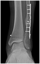 Football Ankle Fracture