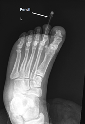 Foreign Body in the Foot