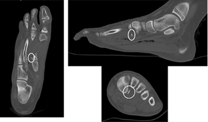 Foreign Body in the Foot