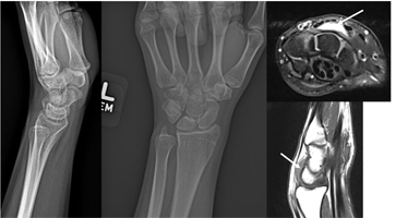 Ganglion Cyst of the Wrist