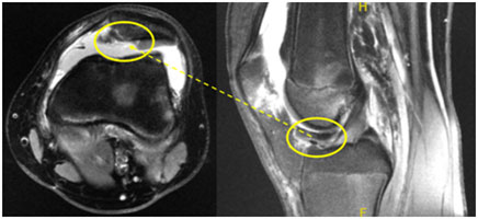 Gymnastics Patella Dislocation