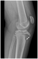 Handball Knee Fracture