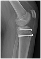 Handball Knee Fracture