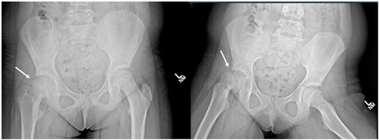 Slipped Capital Femoral Epiphysis (SCFE) – Hip Problem Masquerading as Chronic Knee Pain