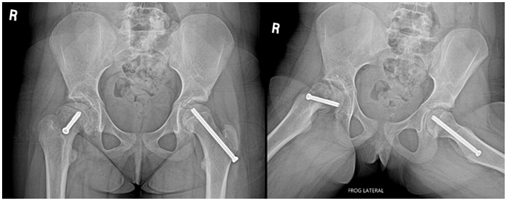 Slipped Capital Femoral Epiphysis (SCFE) – Hip Problem Masquerading as Chronic Knee Pain