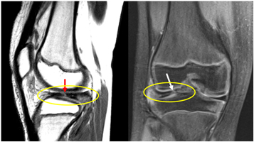 Knee Pain/Clicking from a Symptomatic Discoid Lateral Meniscus