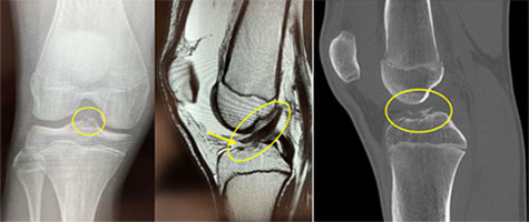 Lacrosse ACL Injury