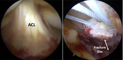 Lacrosse ACL Injury