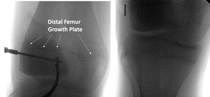 Lacrosse ACL Injury