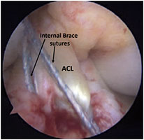 Lacrosse ACL Injury